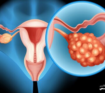 روش های درمانی سرطان تخمدان را بشناسید - 12