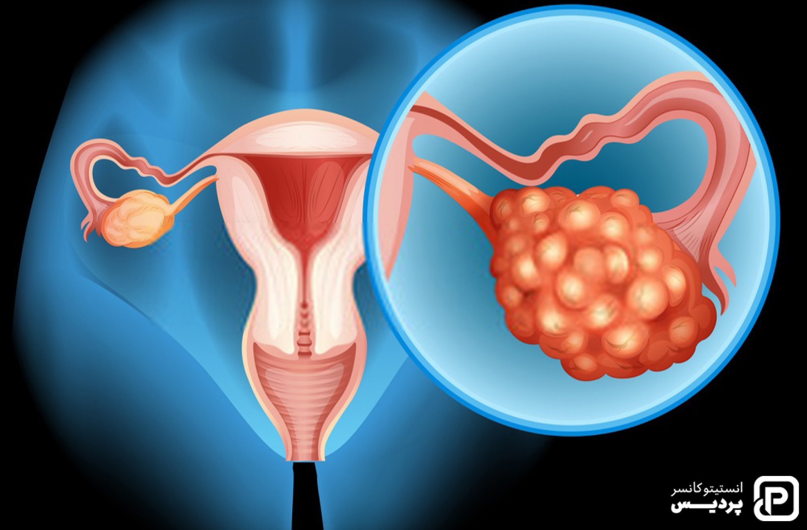 روش های درمانی سرطان تخمدان را بشناسید 1 روش های درمانی سرطان تخمدان را بشناسید - 1