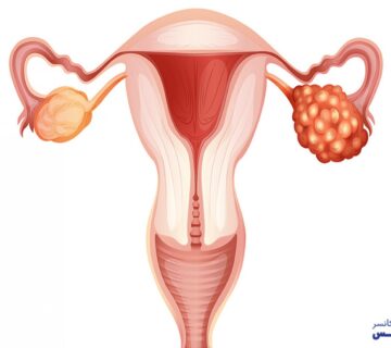 7 عامل افزایش خطر سرطان تخمدان - 8