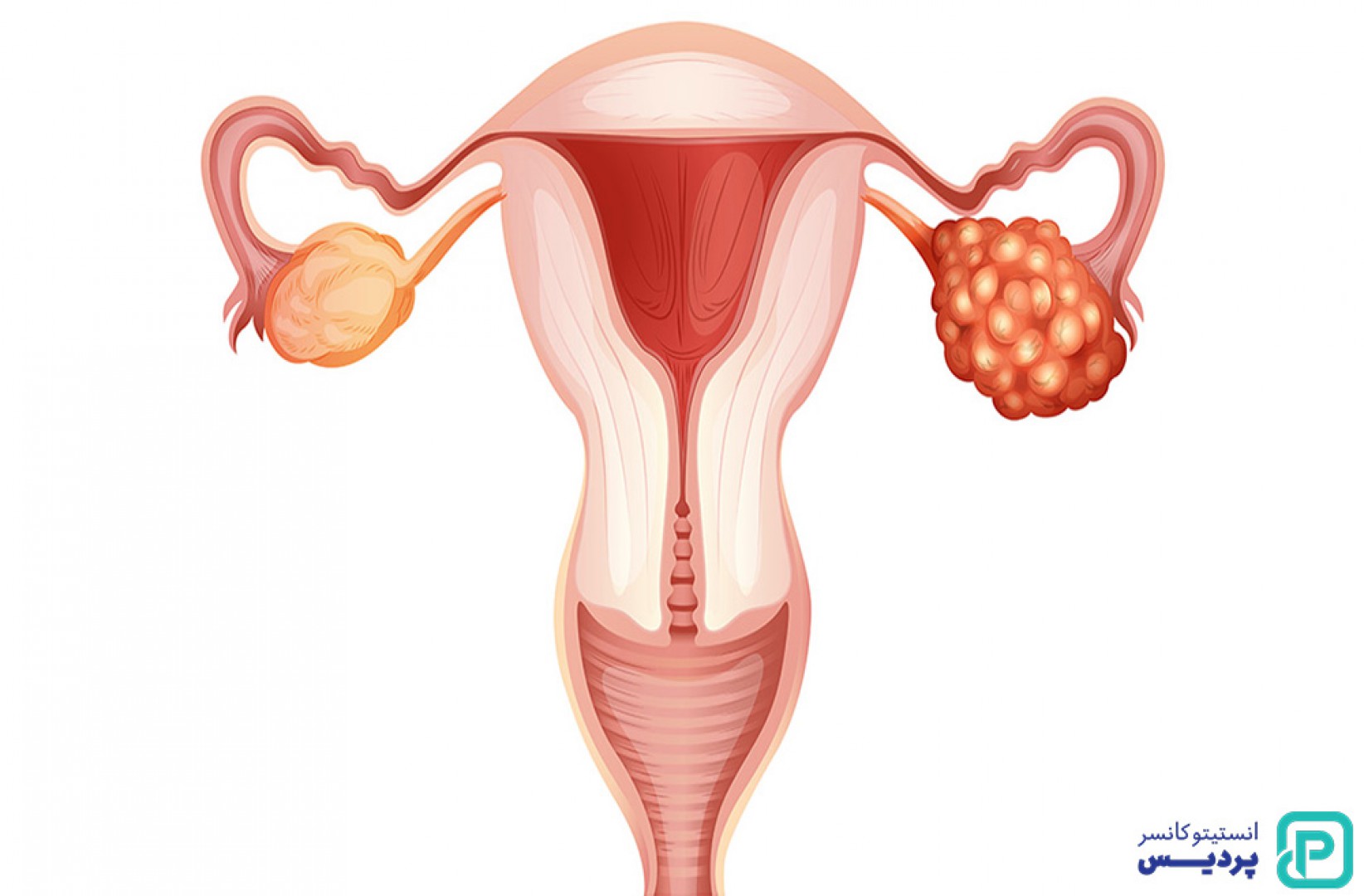 7 عامل افزایش خطر سرطان تخمدان 1 Image 655e4628038e4