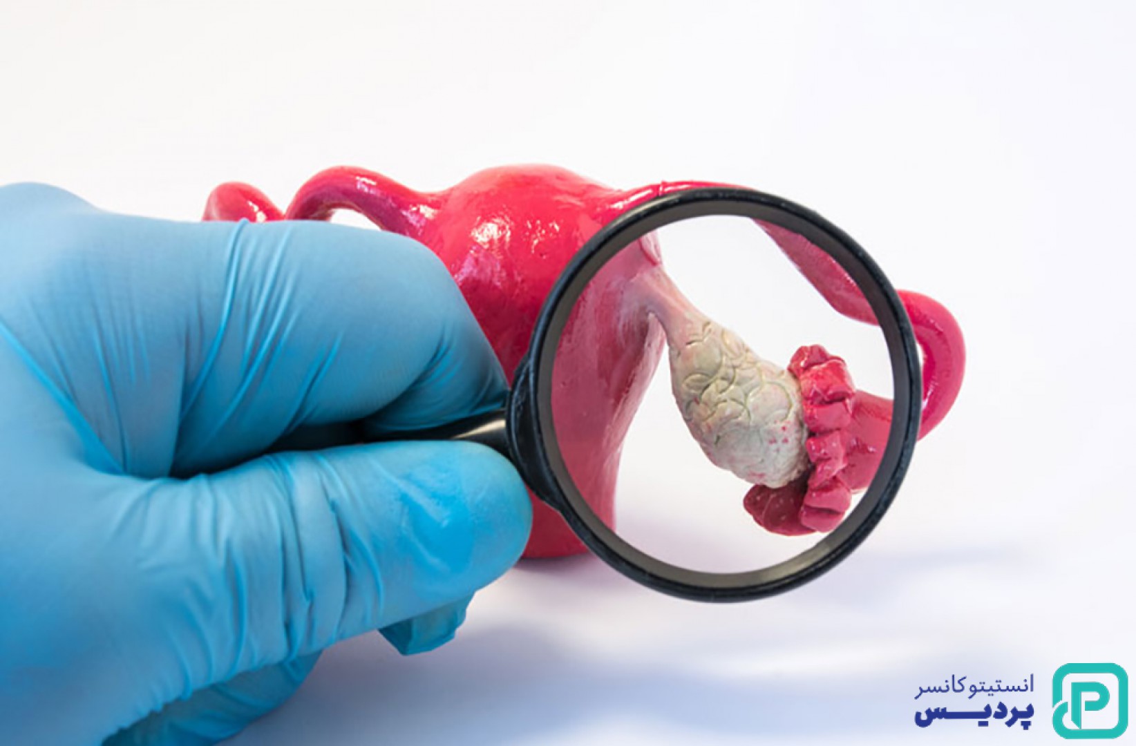 همه چیز درباره مرحله بندی سرطان تخمدان - 1