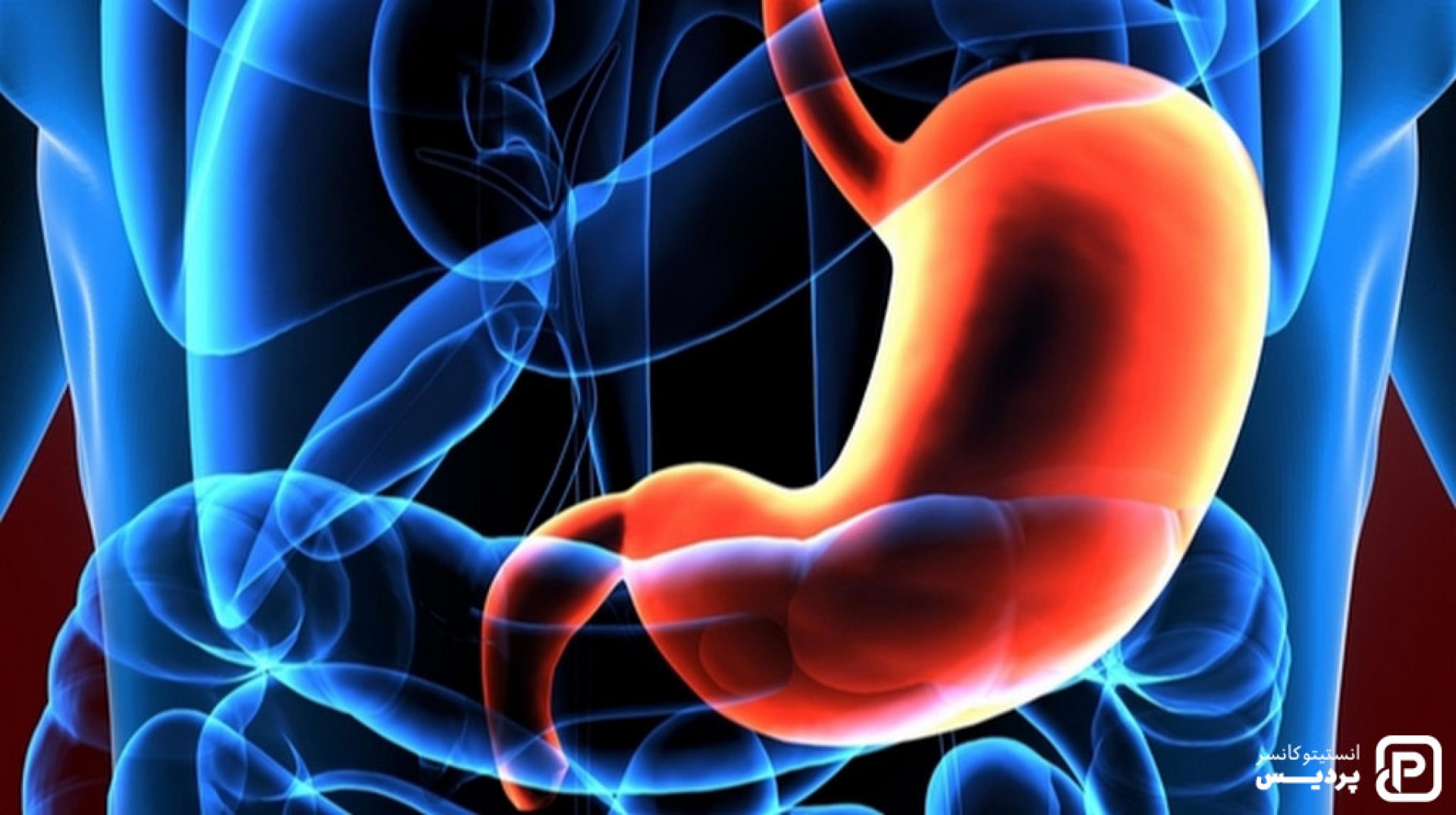 علائم سرطان معده؛ نشانه‌ها، دلایل و روش‌های تشخیص - 1