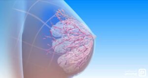 سرطان سینه و هر آنچه که درباره سرطان پستان باید بدانید - 11