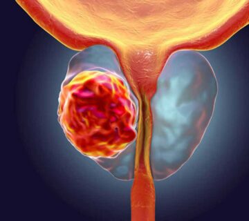 سرطان پروستات، نشانه ها و راههای تشخیص و درمان آن - 5