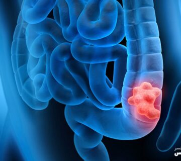 هر آنچه در مورد سرطان روده بزرگ باید بدانید - 7