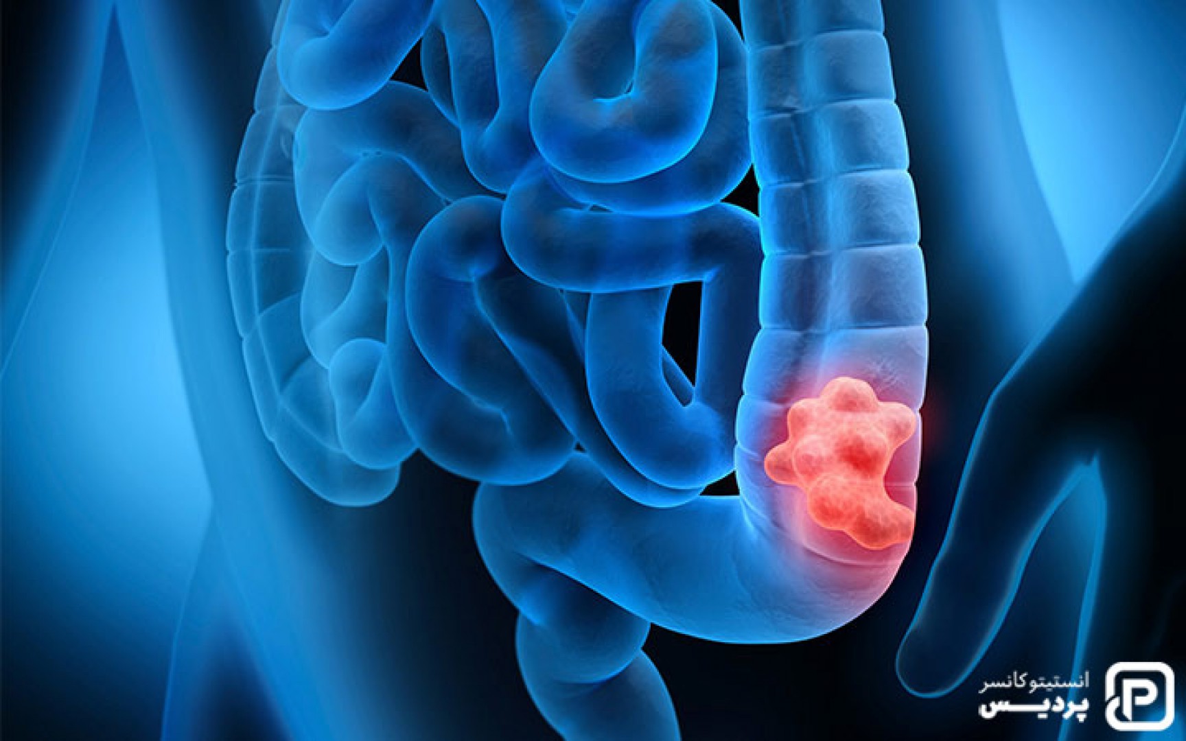 هر آنچه در مورد سرطان روده بزرگ باید بدانید - 1