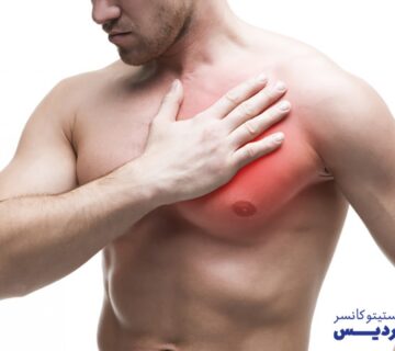 هورمون درمانی و پرتو درمانی سرطان سینه مردان - 33