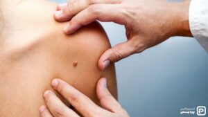 سرطان پوست، از علائم و نشانه ها تا راههای تشخیص و درمان - 6