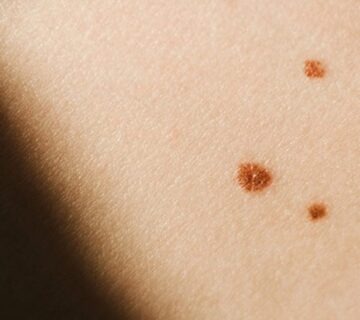 سرطان پوست ملانوما چیست - 8