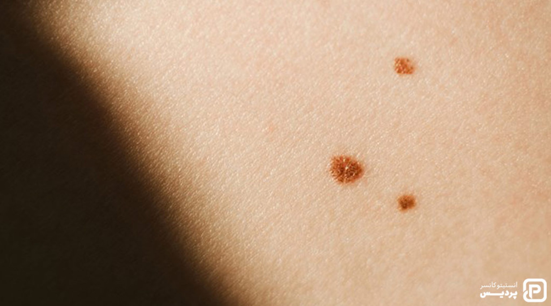 سرطان پوست ملانوما چیست 1 سرطان پوست ملانوما چیست - 1