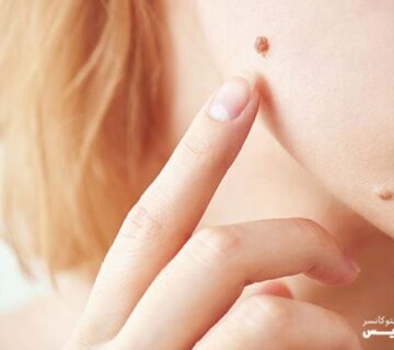انواع سرطان پوست را بشناسید - 7
