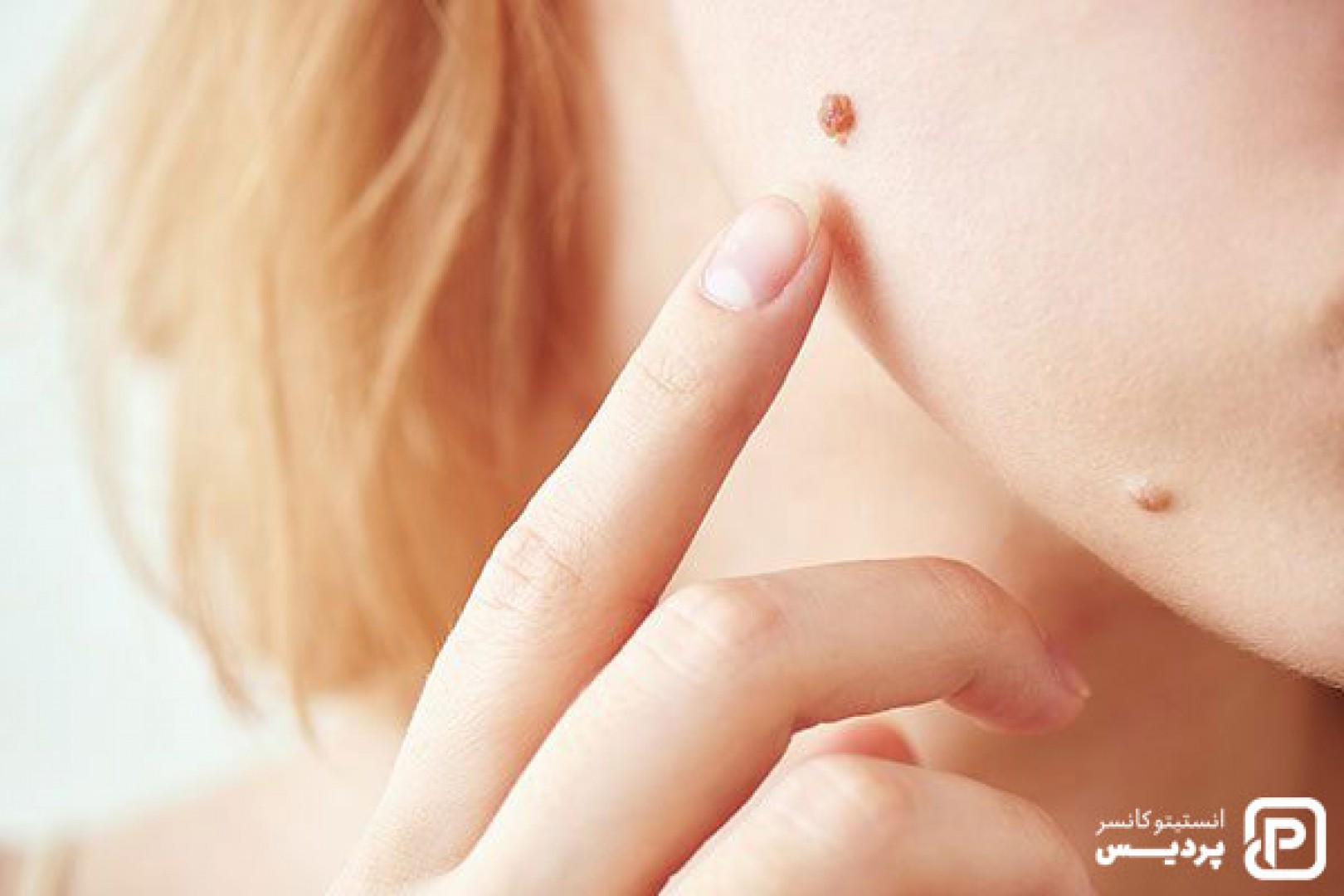 انواع سرطان پوست را بشناسید 1 انواع سرطان پوست را بشناسید - 1