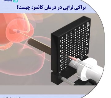 براکی تراپی در درمان کانسر چیست؟ - 3