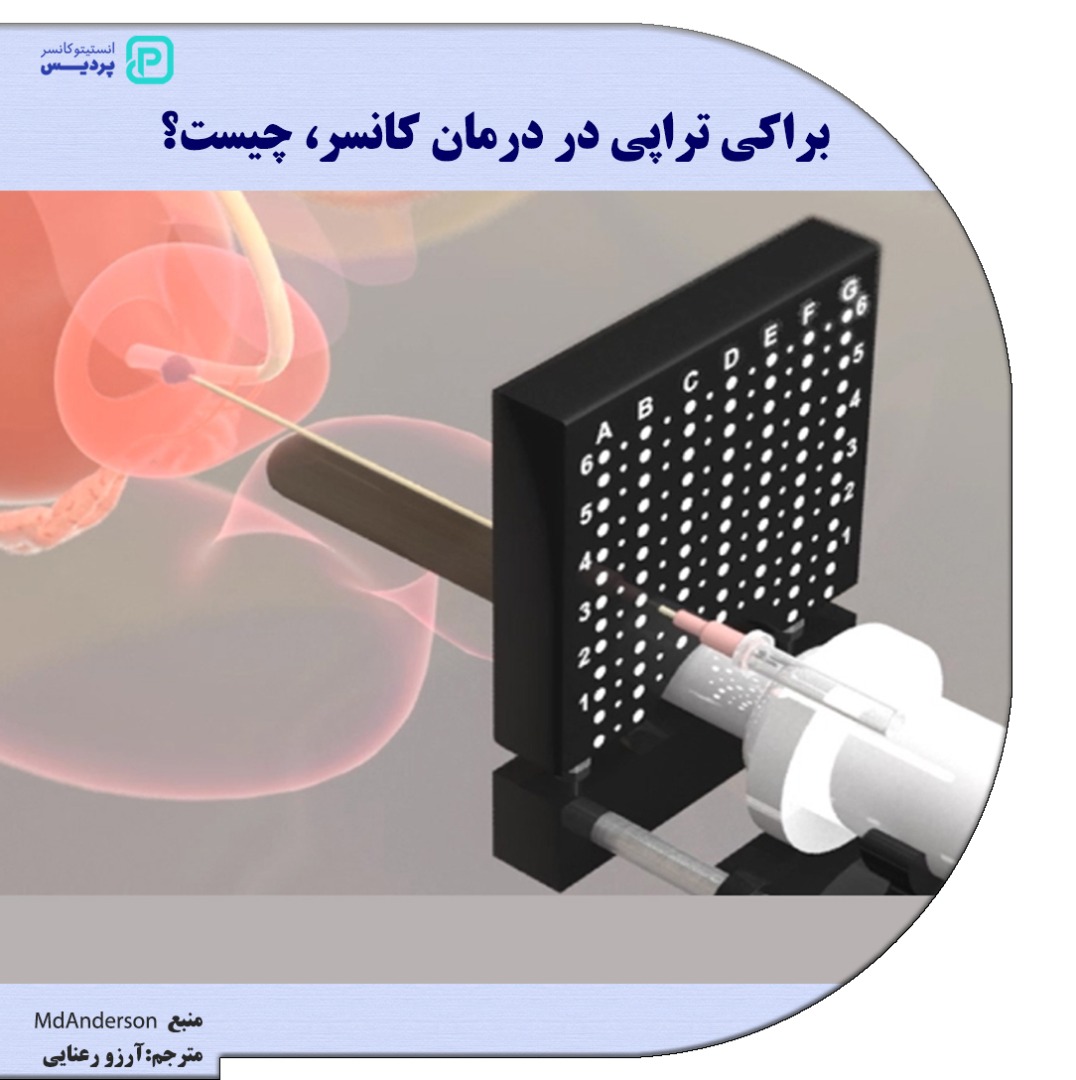 براکی تراپی در درمان کانسر چیست؟ 1 براکی تراپی در درمان کانسر چیست؟ - 1