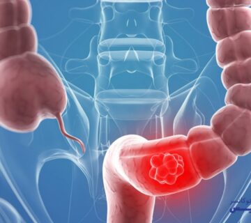 درباره غربالگری سرطان کولورکتال (سرطان روده بزرگ) بیشتر بدانید - 5