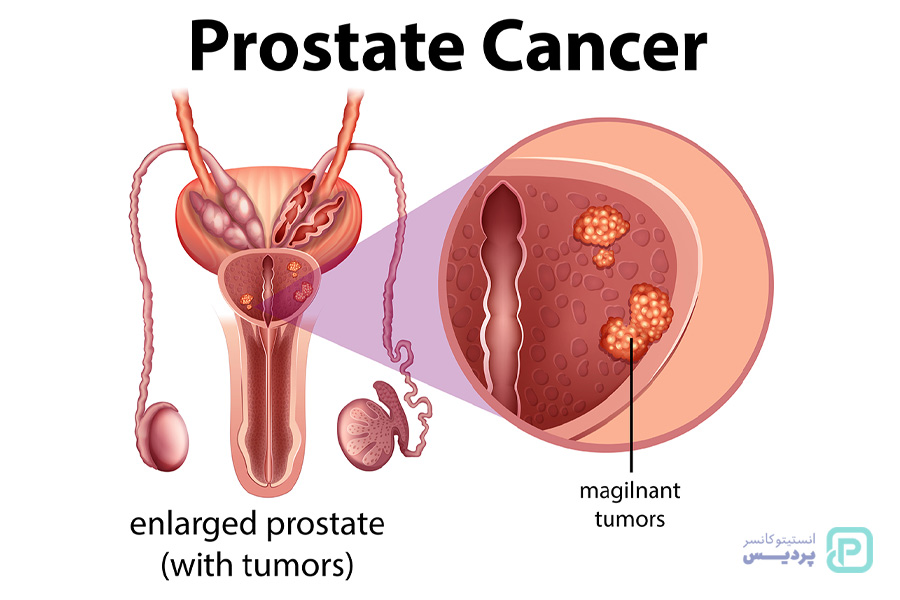 انواع نادر سرطان پروستات را بشناسید - 2