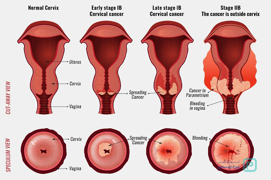 سرطان دهانه رحم چیست؟ علائم اولیه و راه‌های تشخیص - 7