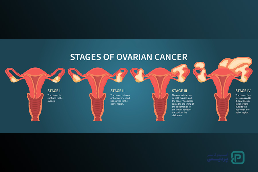 همه چیز درباره مرحله بندی سرطان تخمدان - 3