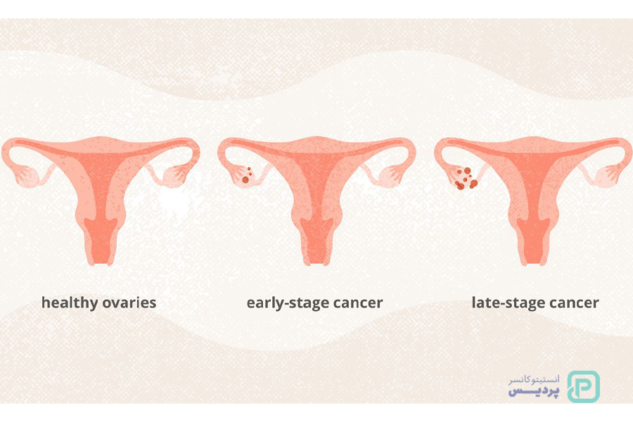 همه چیز درباره مرحله بندی سرطان تخمدان - 2