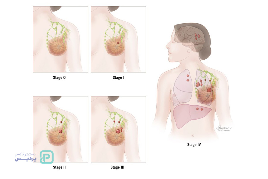 همه چیز درباره مرحله بندی سرطان سینه