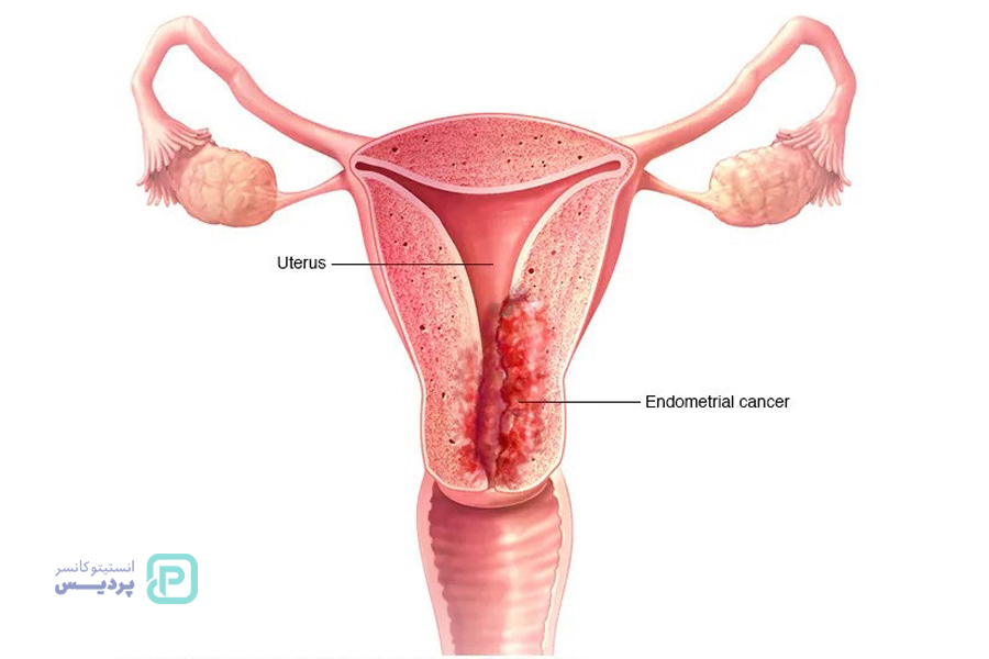 انواع روش های درمان سرطان دهانه رحم - 2