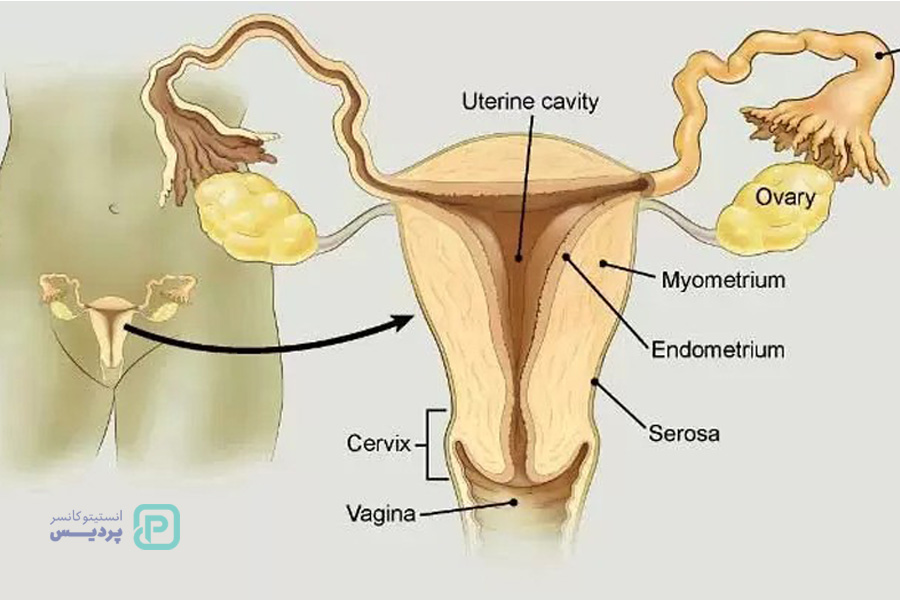 سرطان دهانه رحم و درمان آن