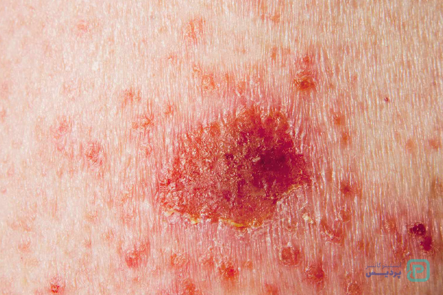 سرطان پوست سلول پایه و سنگفرشی 2 انواع سرطان پوست