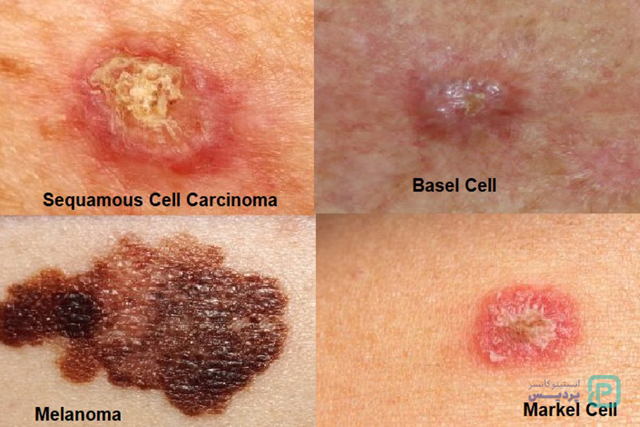 سرطان پوست سلول پایه و سنگفرشی 4 همه چیز درباره سرطان پوست