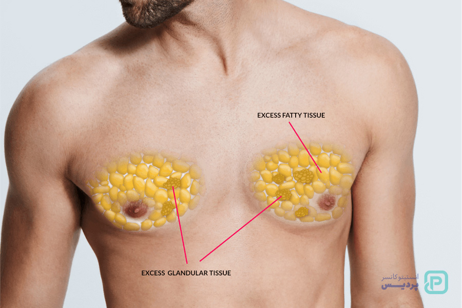 جراحی برای درمان سران سینه مردان