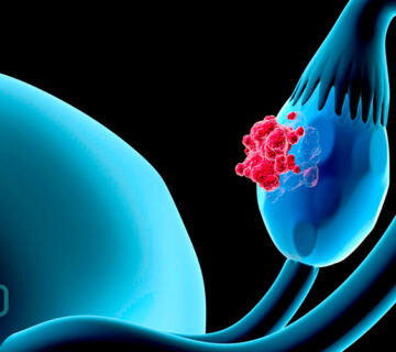سرطان تخمدان چیست؟ تشخیص و علائم سرطان تخمدان - 7