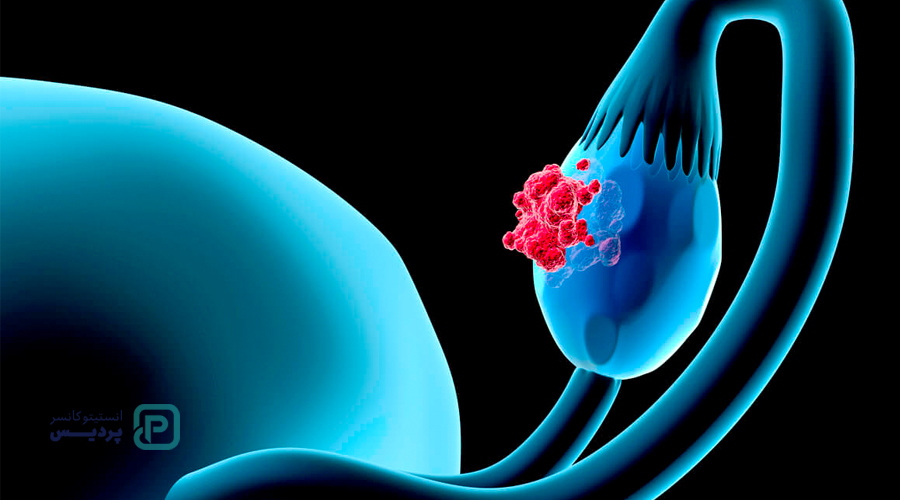 سرطان تخمدان چیست؟ تشخیص و علائم سرطان تخمدان 1 سرطان تخمدان چیست؟ تشخیص و علائم سرطان تخمدان - 1