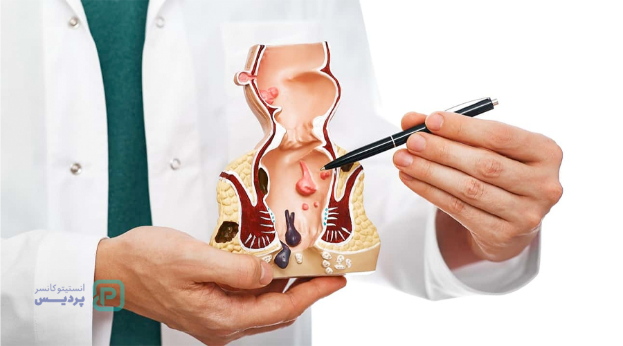 علائم سرطان مقعد چیست؟ تشخیص و درمان - 1