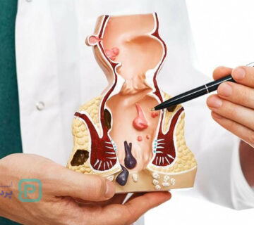تفاوت بواسیر و سرطان مقعدی | چگونه تفاوت را تشخیص دهیم؟ - 9