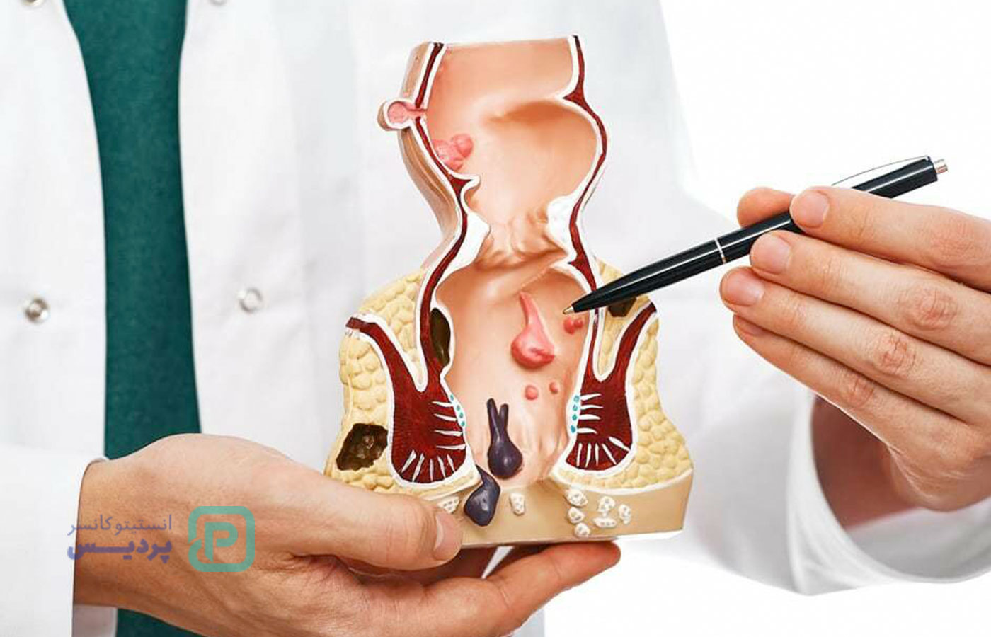 تفاوت بواسیر و سرطان مقعدی | چگونه تفاوت را تشخیص دهیم؟ 1 تفاوت بواسیر و سرطان مقعدی | چگونه تفاوت را تشخیص دهیم؟ - 1