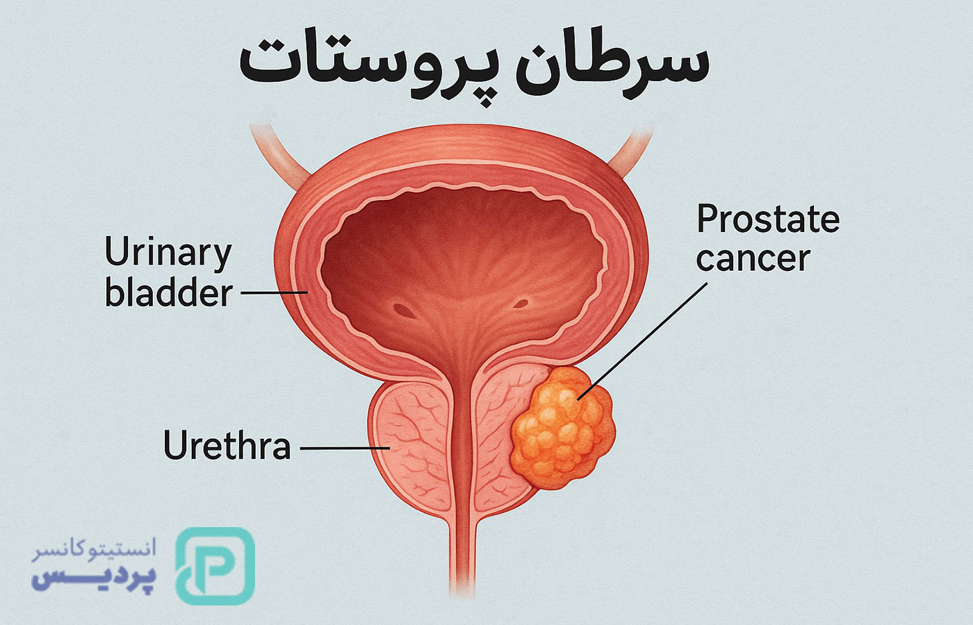 دلایل ابتلا به بیماریهای پروستات | هر آنچه باید درباره پروستات، علائم و راههای پیشگیری بدانید 1 دلایل ابتلا به بیماریهای پروستات | هر آنچه باید درباره پروستات، علائم و راههای پیشگیری بدانید - 1