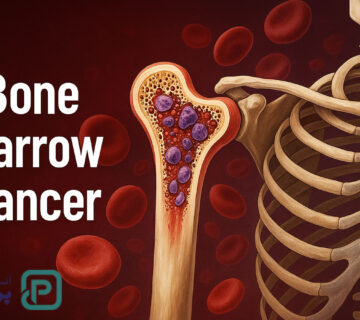 سرطان مغز استخوان چیست؟ علائم، انواع و روش‌های درمان مؤثر - 16
