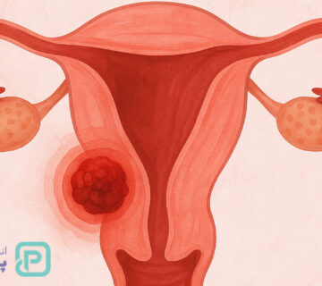 علائم سرطان رحم: نشانه‌هایی که هر زنی باید بشناسد - 30