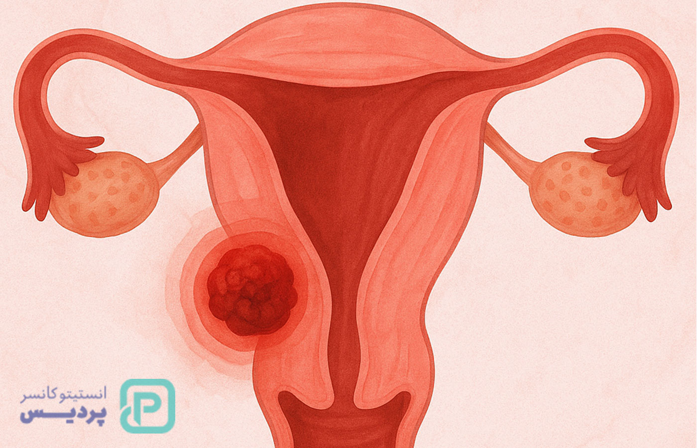علائم سرطان رحم: نشانههایی که هر زنی باید بشناسد 1 علائم سرطان رحم: نشانههایی که هر زنی باید بشناسد - 1