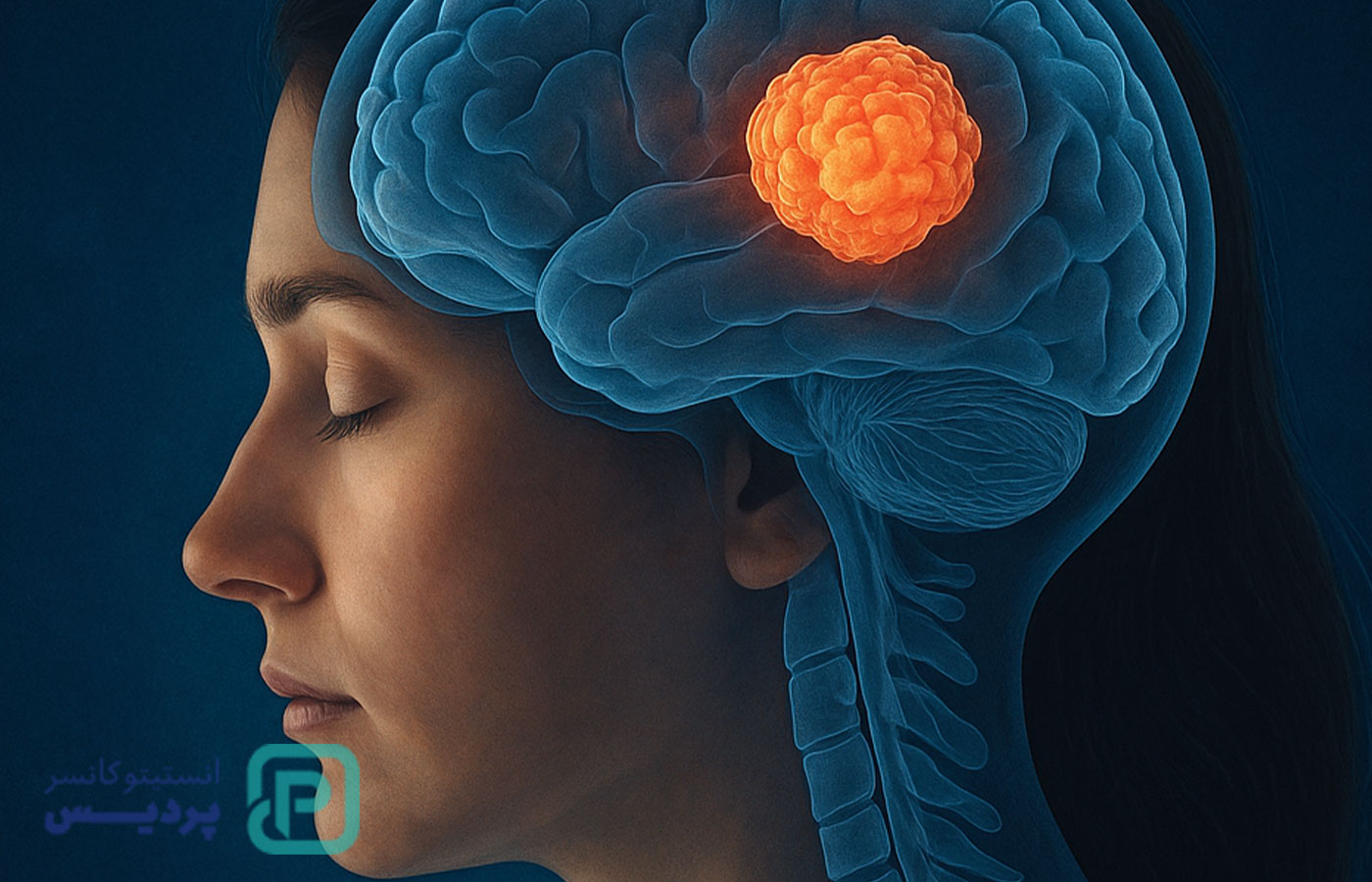 همه چیز درباره تومور مغزی: از نشانه‌ها تا درمان‌های نوین - 1