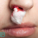 خون دماغ و سرطان | آیا خون دماغ شدن مکرر می‌تواند نشانه سرطان باشد؟ - 12