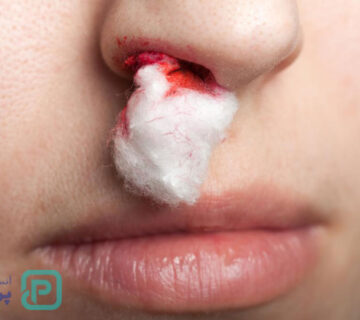 خون دماغ و سرطان | آیا خون دماغ شدن مکرر می‌تواند نشانه سرطان باشد؟ - 3