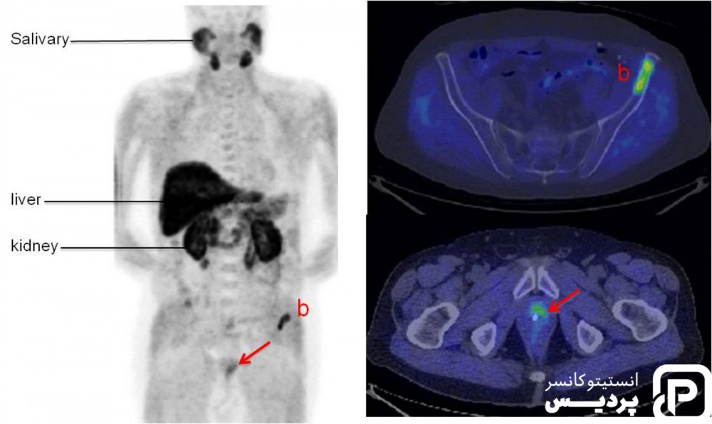 تشخیص به موقع سرطان پروستات