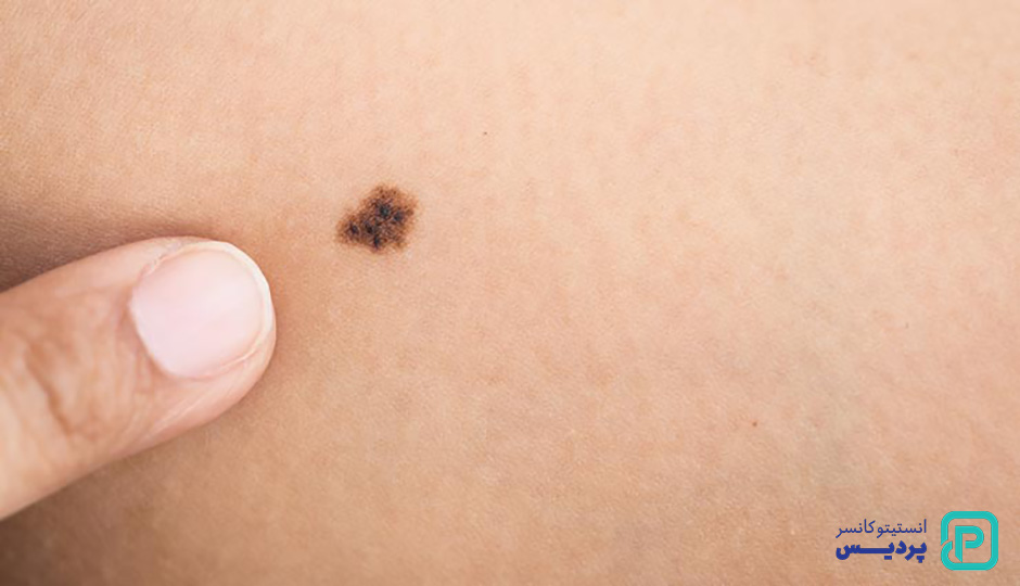 سرطان پوست سلول پایه و سنگفرشی 3 سرطان پوست