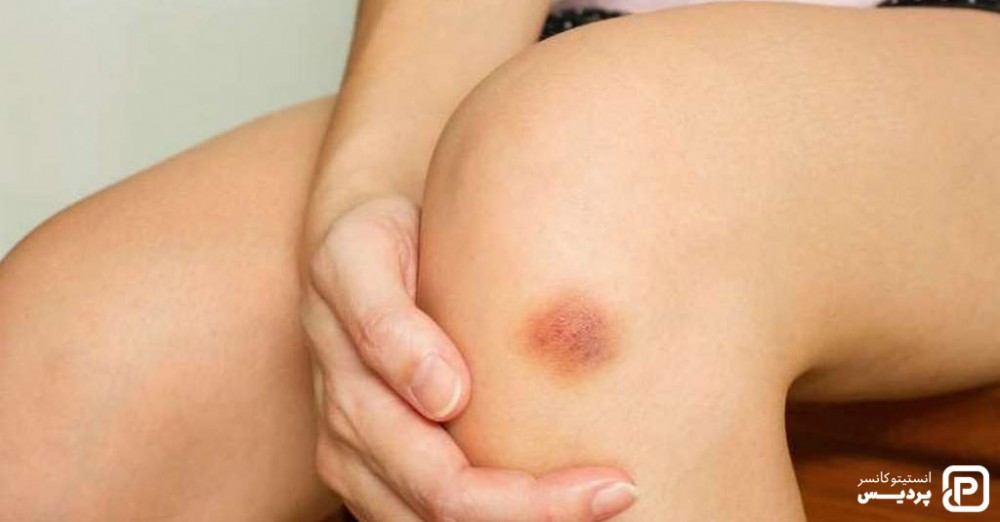 کبودی و قرمز شدن پوست از علائم سرطان خون می باشد