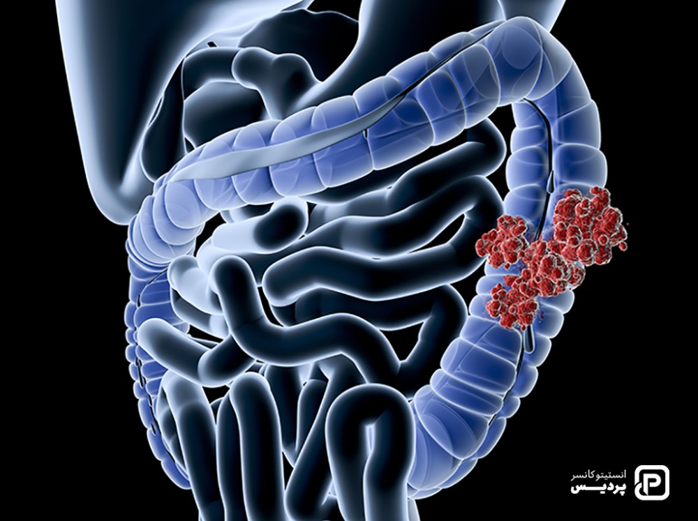 غربالگری-سرطان-کولورکتال
