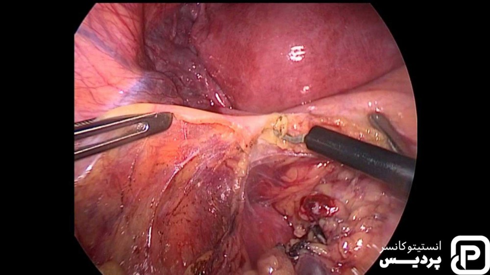  سرطان روده چگونه تشخیص داده می شود؟