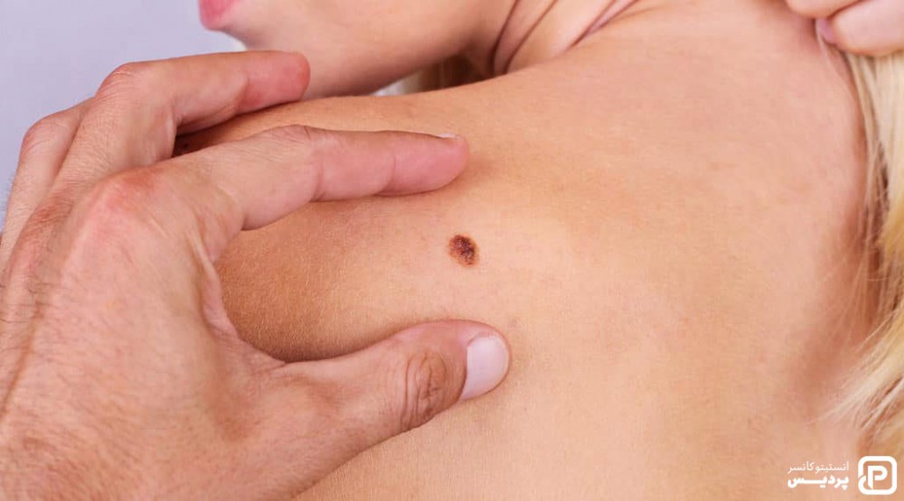 سرطان پوست ملانوما چیست 2 ملانوما چیست