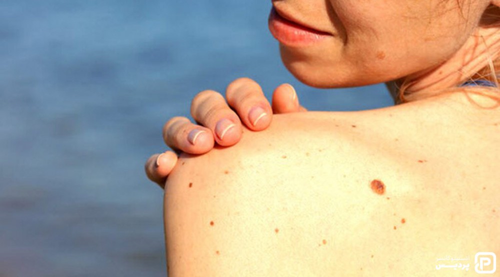 سرطان پوست ملانوما چیست 4 علت اصلی ملانوما اشعه ماورا بنفش و تخت های برنزه است