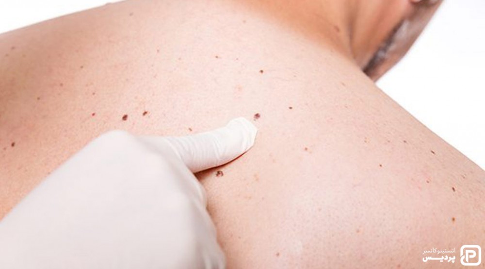سرطان پوست ملانوما چیست 5 پیشگیری از ملانوما