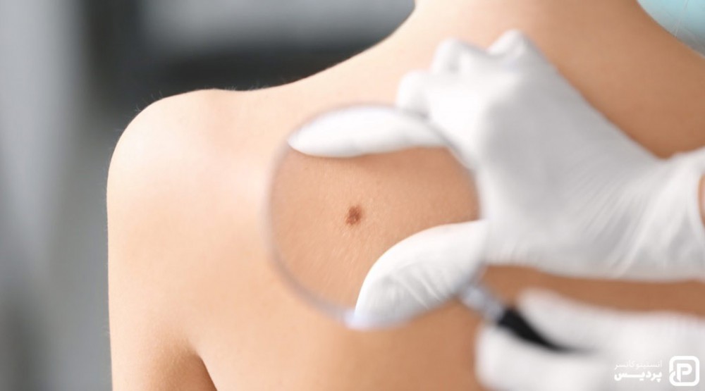 سرطان پوست ملانوما چیست 6 راههای تشخیص ملانوما